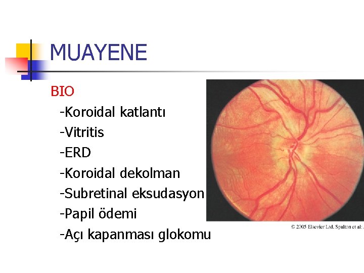 MUAYENE BIO -Koroidal katlantı -Vitritis -ERD -Koroidal dekolman -Subretinal eksudasyon -Papil ödemi -Açı kapanması