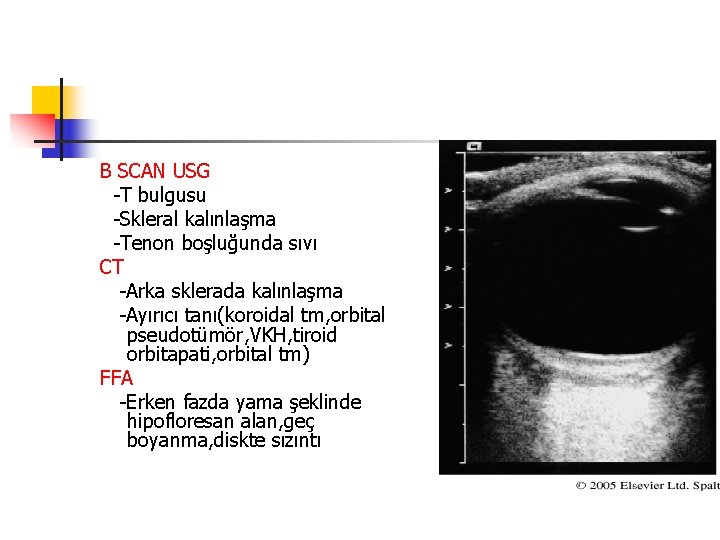 B SCAN USG -T bulgusu -Skleral kalınlaşma -Tenon boşluğunda sıvı CT -Arka sklerada kalınlaşma