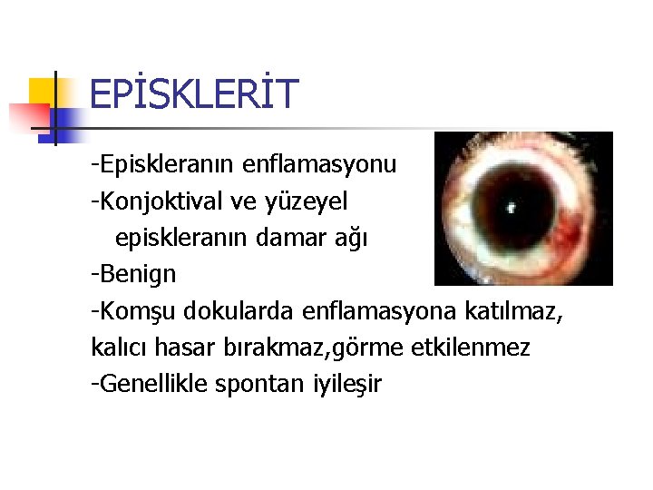 EPİSKLERİT -Episkleranın enflamasyonu -Konjoktival ve yüzeyel episkleranın damar ağı -Benign -Komşu dokularda enflamasyona katılmaz,