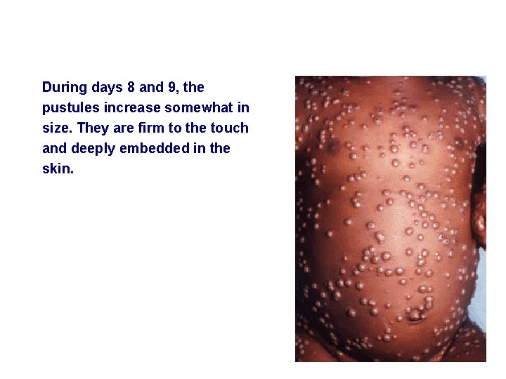 During days 8 and 9, the pustules increase somewhat in size. They are firm