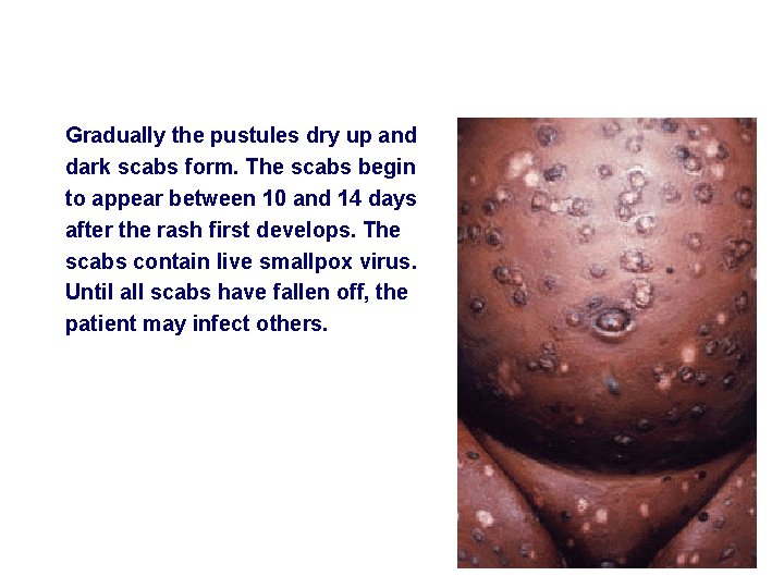 Gradually the pustules dry up and dark scabs form. The scabs begin to appear