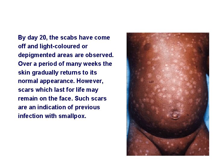 By day 20, the scabs have come off and light-coloured or depigmented areas are