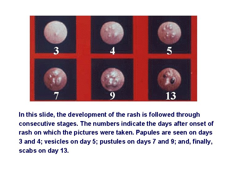 3 4 5 7 9 13 In this slide, the development of the rash