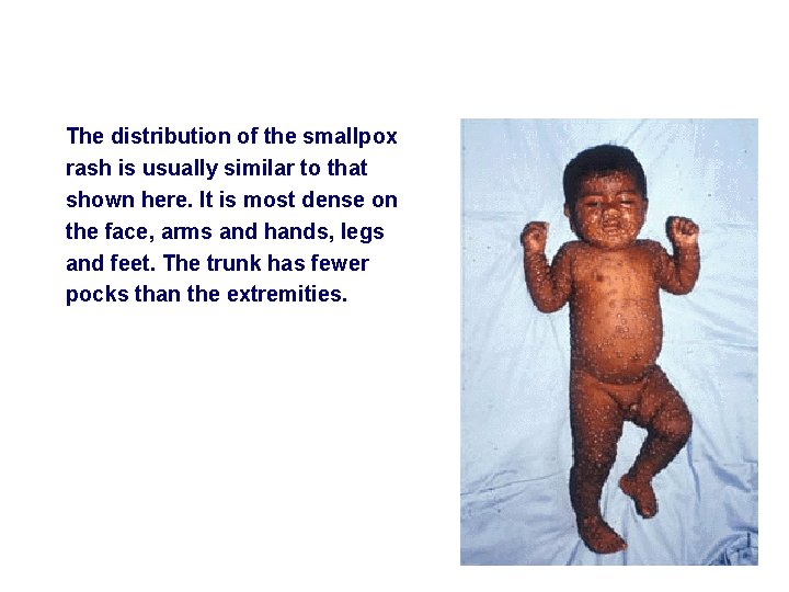 The distribution of the smallpox rash is usually similar to that shown here. It