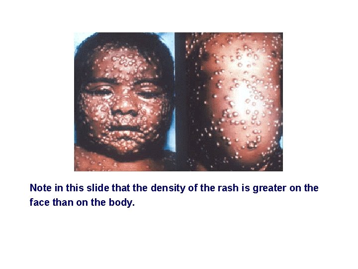 Note in this slide that the density of the rash is greater on the
