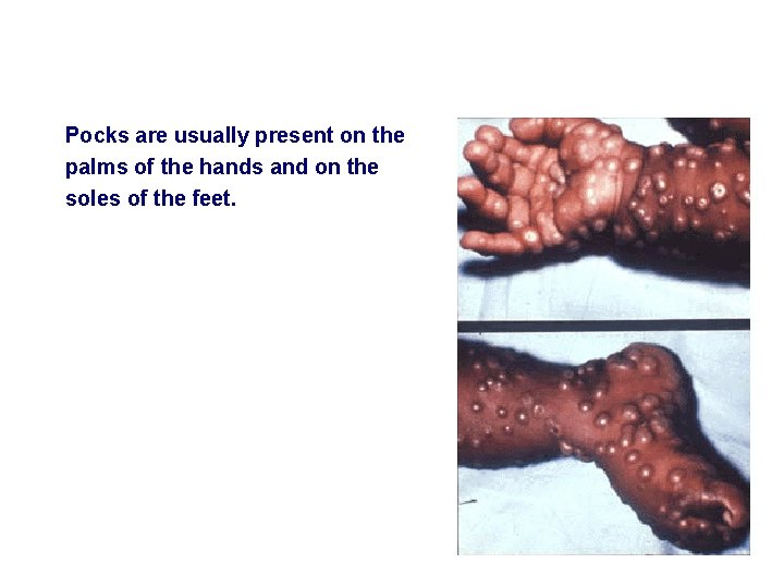Pocks are usually present on the palms of the hands and on the soles