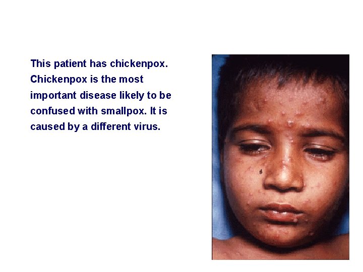 This patient has chickenpox. Chickenpox is the most important disease likely to be confused