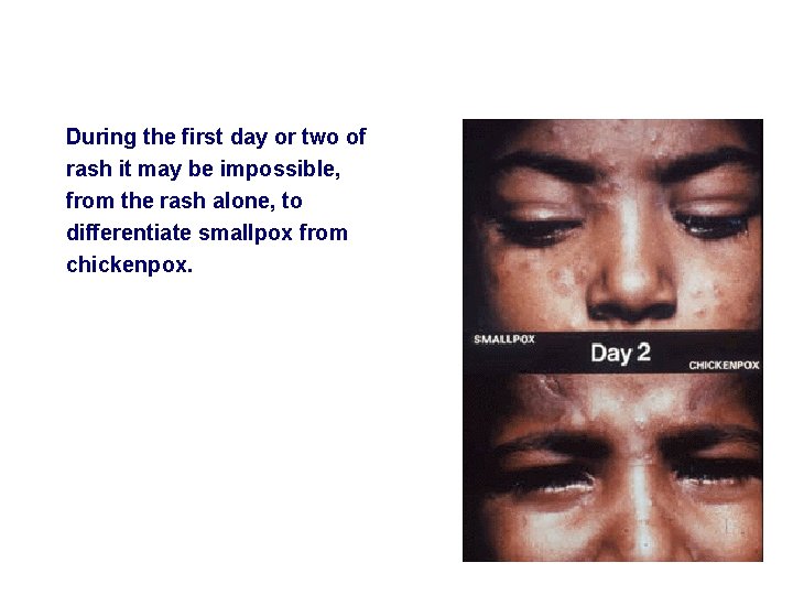 During the first day or two of rash it may be impossible, from the