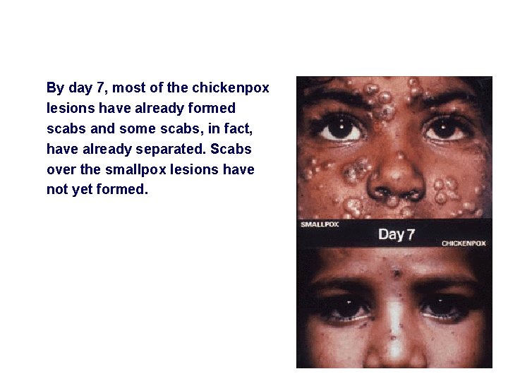 By day 7, most of the chickenpox lesions have already formed scabs and some
