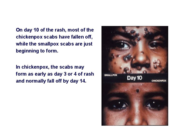 On day 10 of the rash, most of the chickenpox scabs have fallen off,
