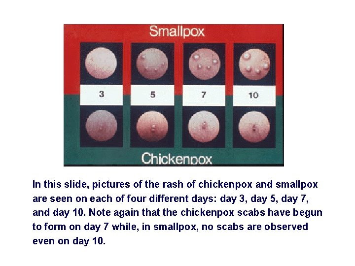 In this slide, pictures of the rash of chickenpox and smallpox are seen on