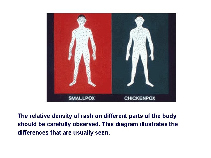 The relative density of rash on different parts of the body should be carefully