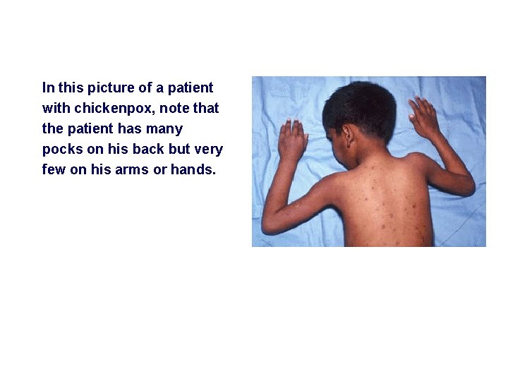 In this picture of a patient with chickenpox, note that the patient has many