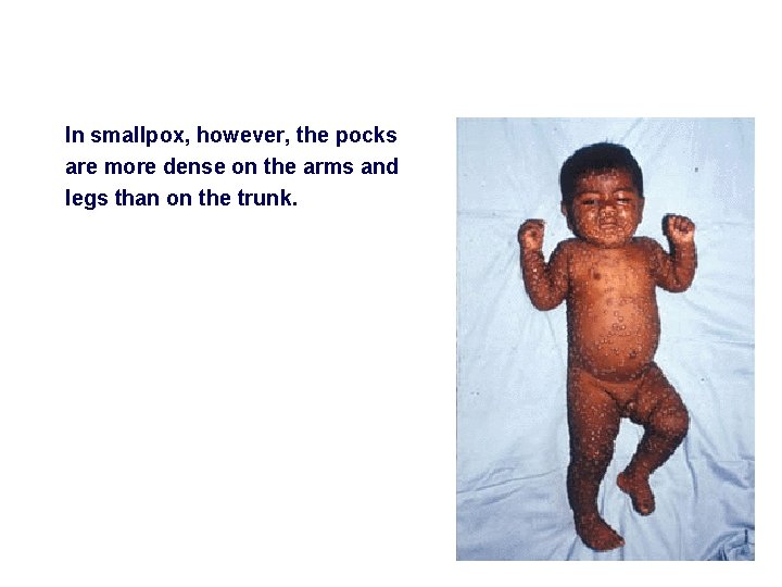 In smallpox, however, the pocks are more dense on the arms and legs than