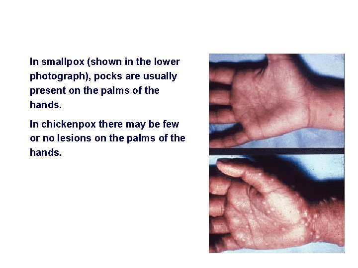 In smallpox (shown in the lower photograph), pocks are usually present on the palms