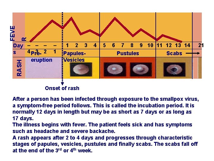 R FEVE RASH Day – – 4 Pre 3 2 1 s eruption 1
