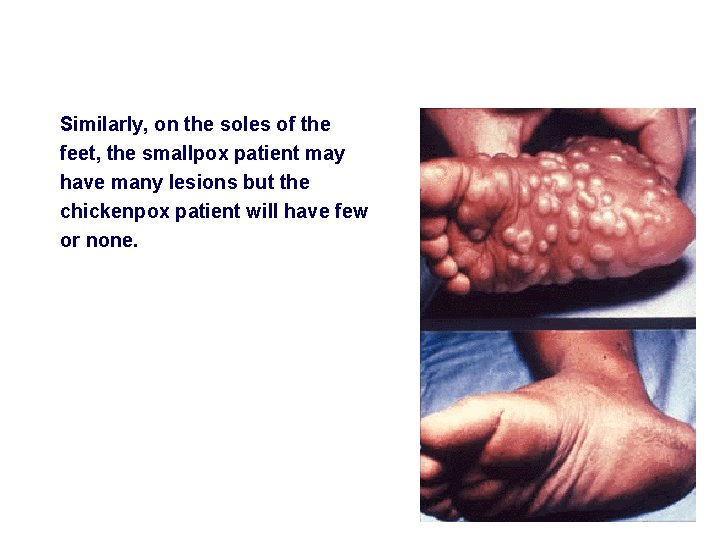 Similarly, on the soles of the feet, the smallpox patient may have many lesions