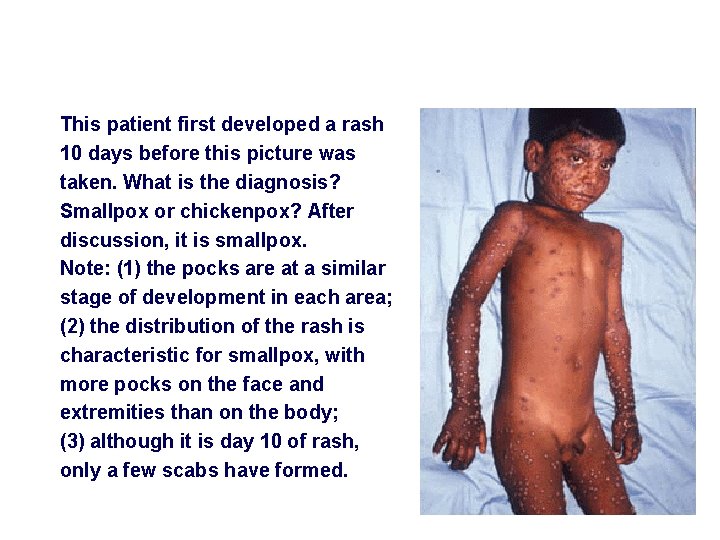 This patient first developed a rash 10 days before this picture was taken. What