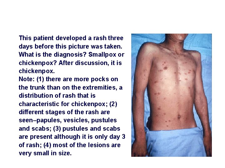 This patient developed a rash three days before this picture was taken. What is