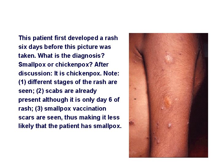 This patient first developed a rash six days before this picture was taken. What