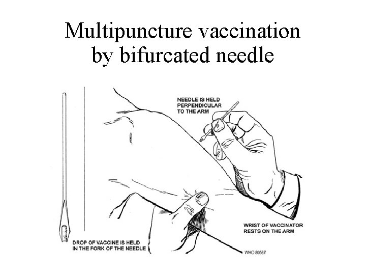 Multipuncture vaccination by bifurcated needle 