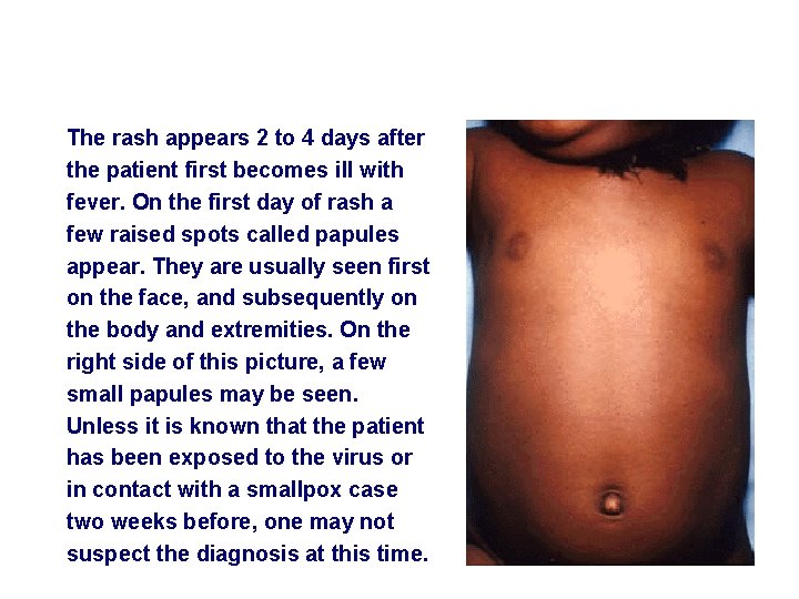 The rash appears 2 to 4 days after the patient first becomes ill with