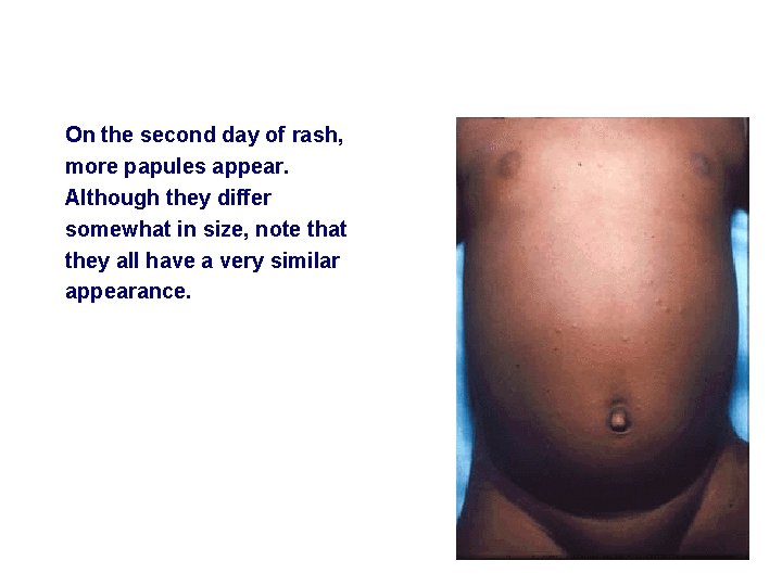 On the second day of rash, more papules appear. Although they differ somewhat in