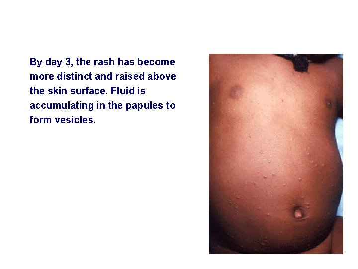 By day 3, the rash has become more distinct and raised above the skin