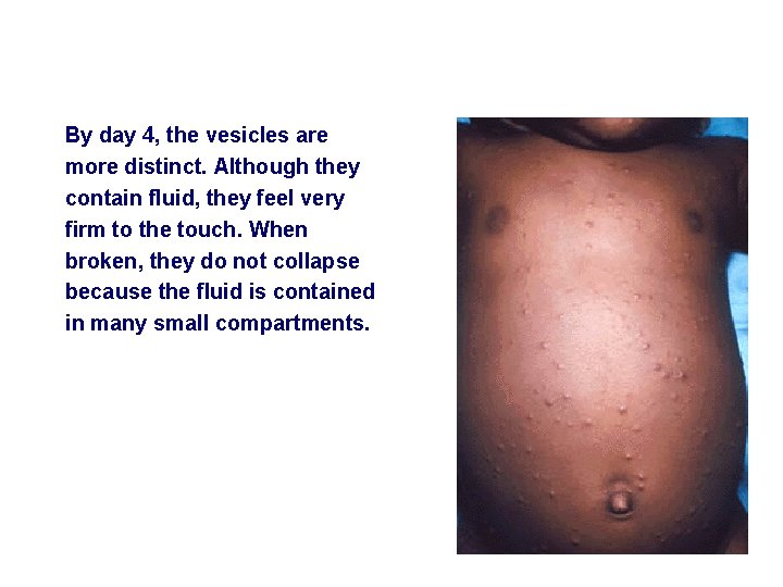 By day 4, the vesicles are more distinct. Although they contain fluid, they feel