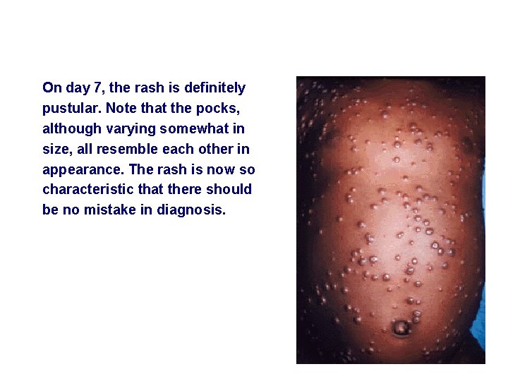 On day 7, the rash is definitely pustular. Note that the pocks, although varying