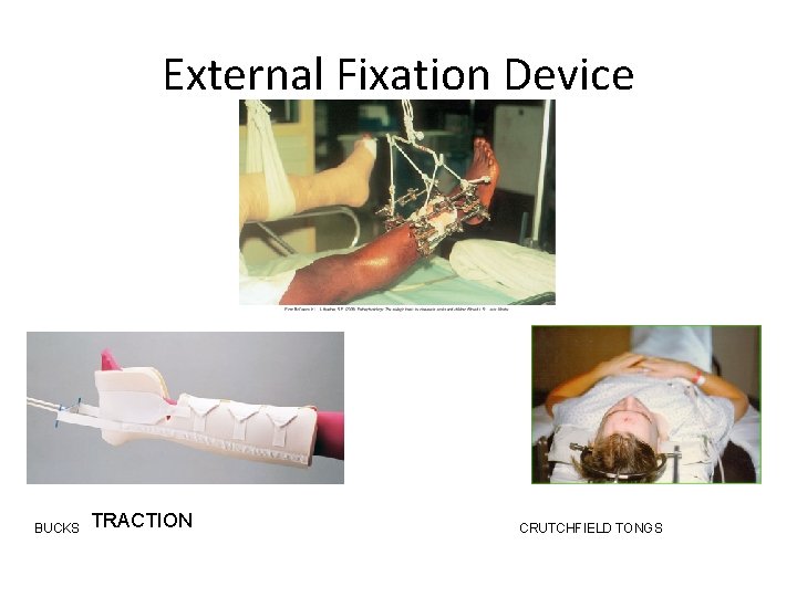 External Fixation Device BUCKS TRACTION CRUTCHFIELD TONGS 