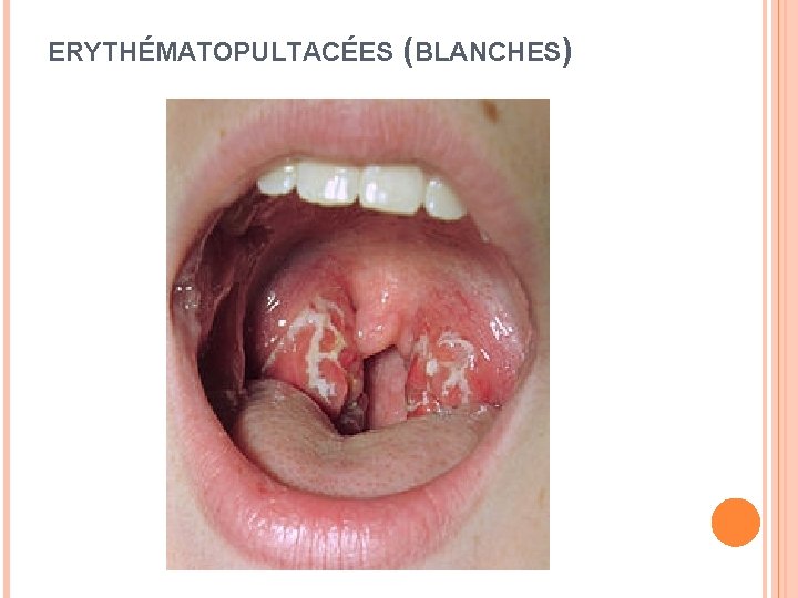 ERYTHÉMATOPULTACÉES (BLANCHES) 