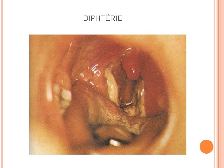 DIPHTÉRIE 