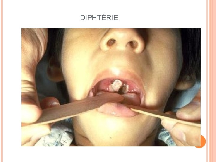 DIPHTÉRIE 