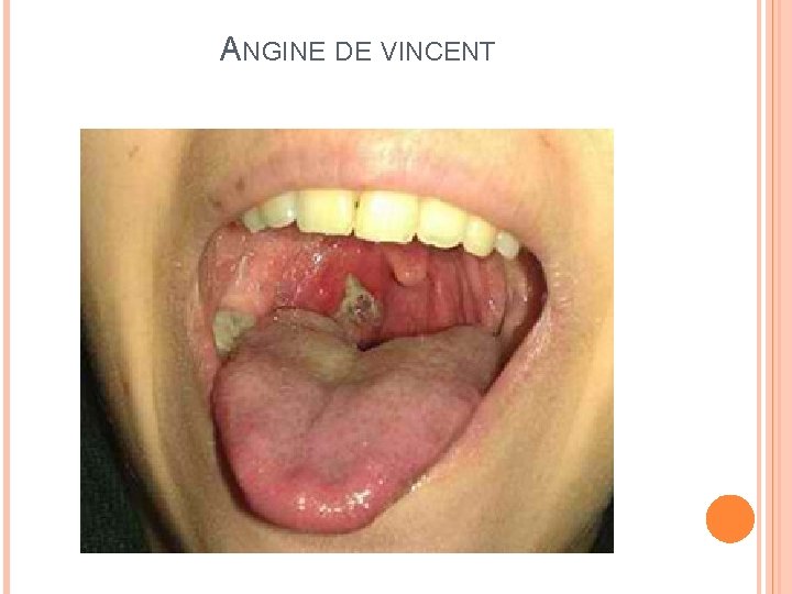 ANGINE DE VINCENT 