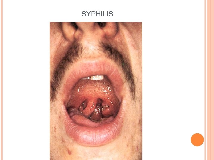 SYPHILIS 