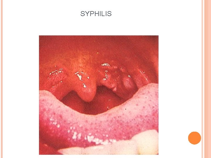 SYPHILIS 