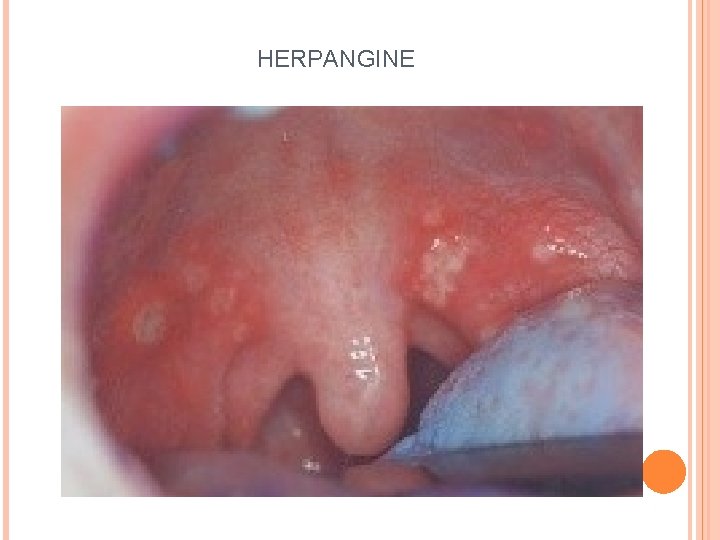 HERPANGINE 