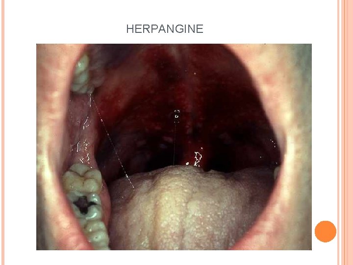 HERPANGINE 