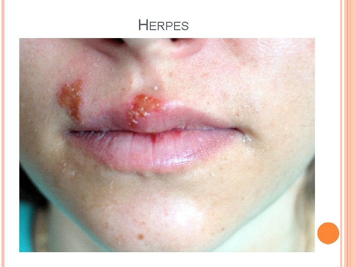 HERPES 