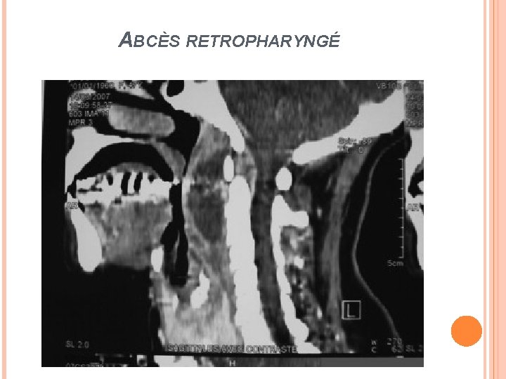 ABCÈS RETROPHARYNGÉ 