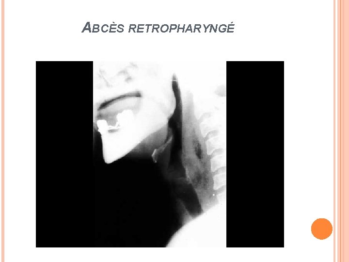 ABCÈS RETROPHARYNGÉ 