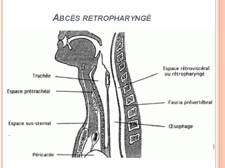 ABCÈS RETROPHARYNGÉ 