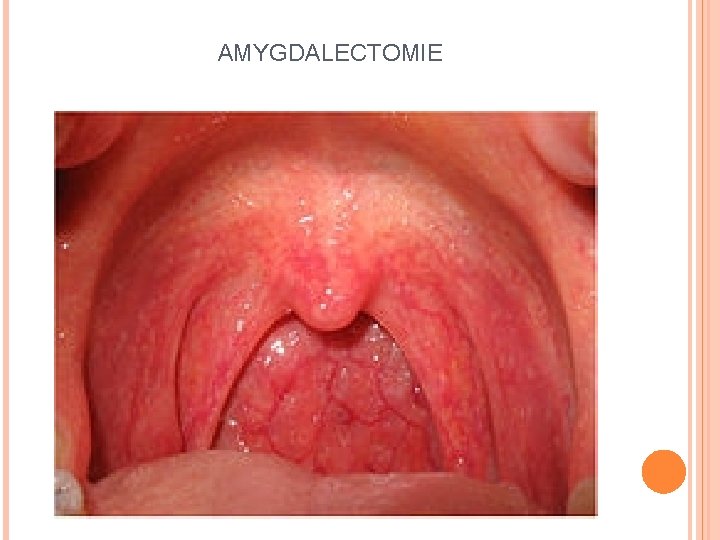 AMYGDALECTOMIE 