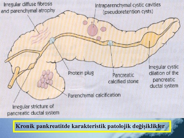 Kronik pankreatitde karakteristik patolojik değişiklikler 