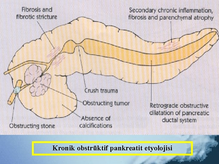 Kronik obstrüktif pankreatit etyolojisi 