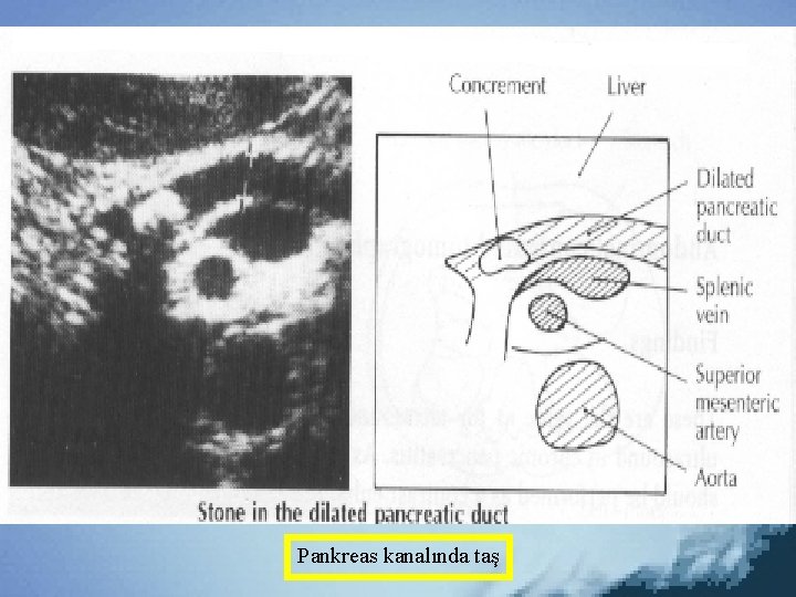 Pankreas kanalında taş 