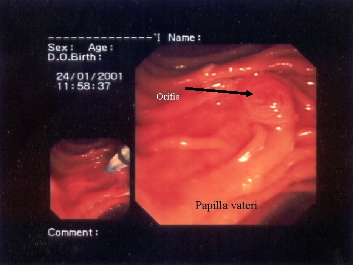 Orifis Papilla vateri 