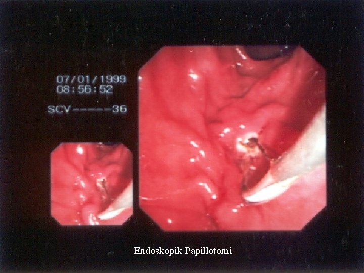 Endoskopik Papillotomi 