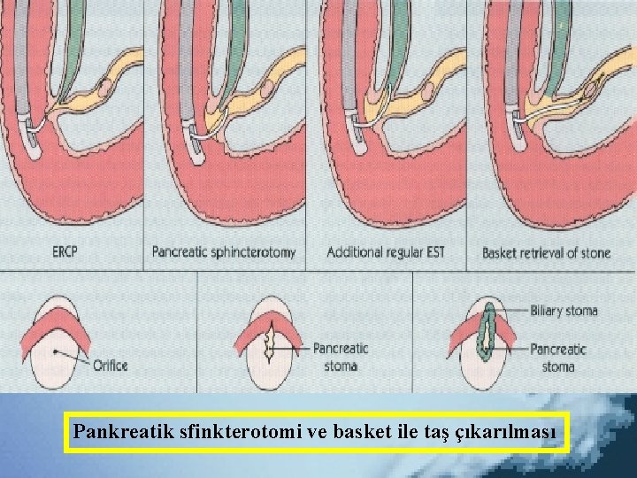 Pankreatik sfinkterotomi ve basket ile taş çıkarılması 